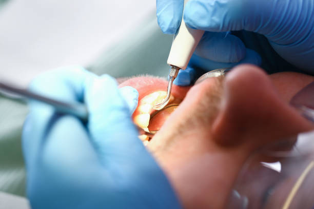 Best Emergency Dentist for Lost Fillings or Crowns in Orange, OH